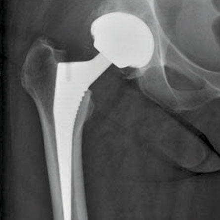 Hip Replacement