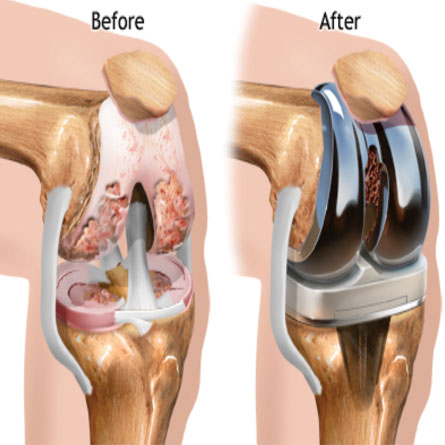 Knee Replacement